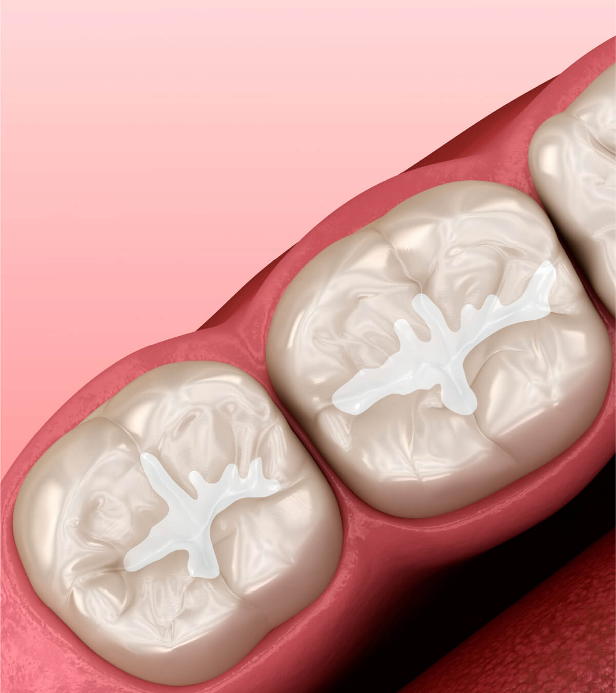 What Are Dental Crowns?